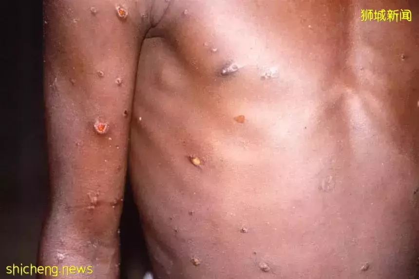 猴痘正以性传播方式蔓延，新加坡出现猴痘病例只是时间问题