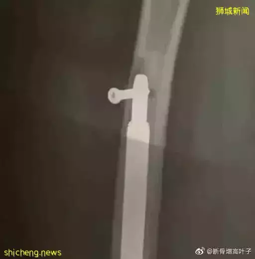 新加坡医生回应!中国女子控诉花50万做“断骨增高”手术失败