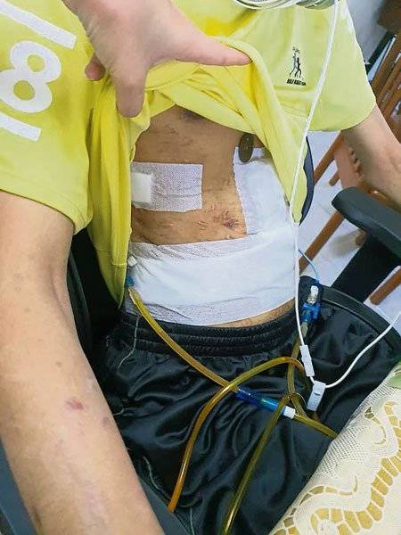 车祸重伤6度手术 青年需百万 狮城移植肝脏