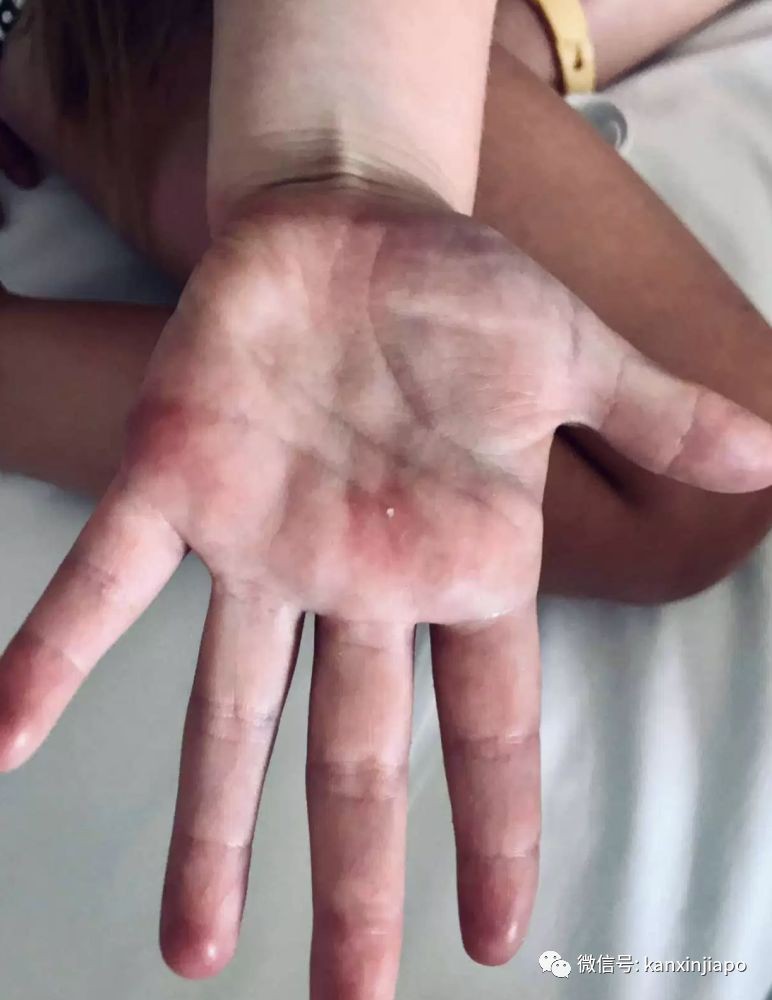 罕见！新加坡5岁女孩游泳后全身红肿，刺痛无比......