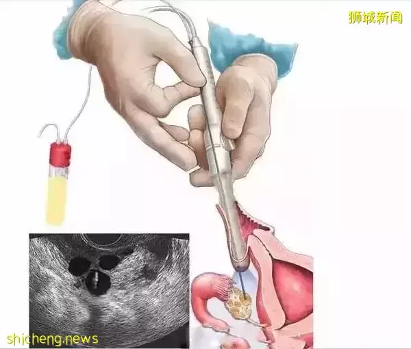 新加坡允许未婚女性做冻卵! 附费用和流程指南