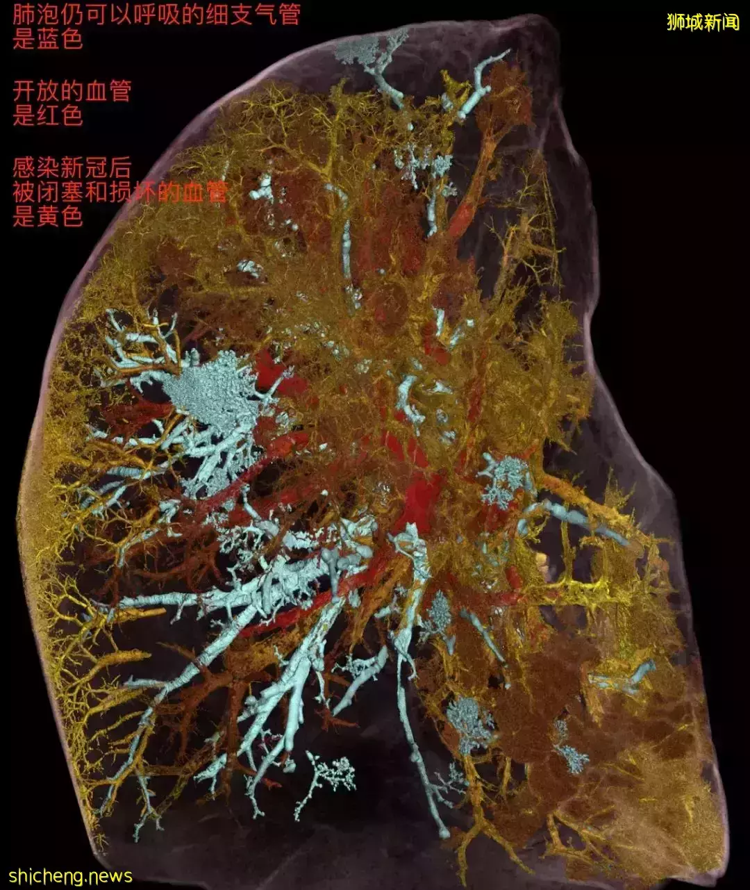 新加坡病例神秘減半，原因在這！57國發現"奧妹"，死亡患者肺部高清照片首曝光