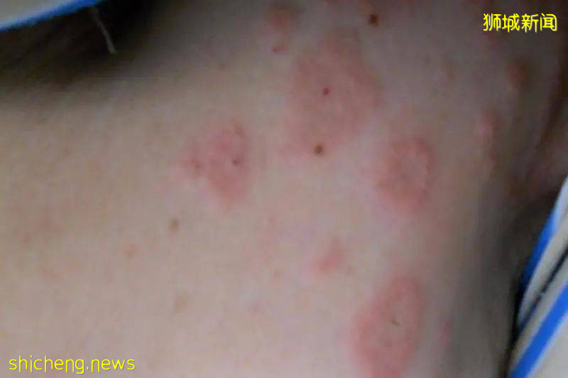 輝瑞/莫德納又曝3種新副作用！正在調查