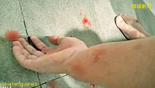 女佣被狗咬伤直流血 雇主只给她一块胶布