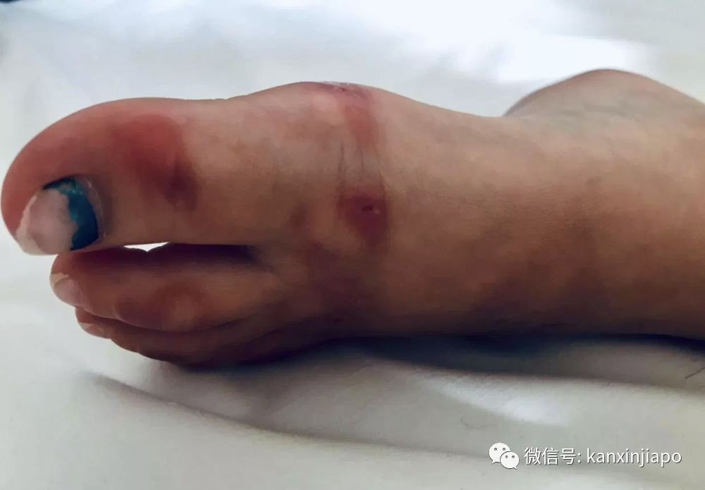 罕见!新加坡5岁女孩游泳后全身红肿,刺痛无比......