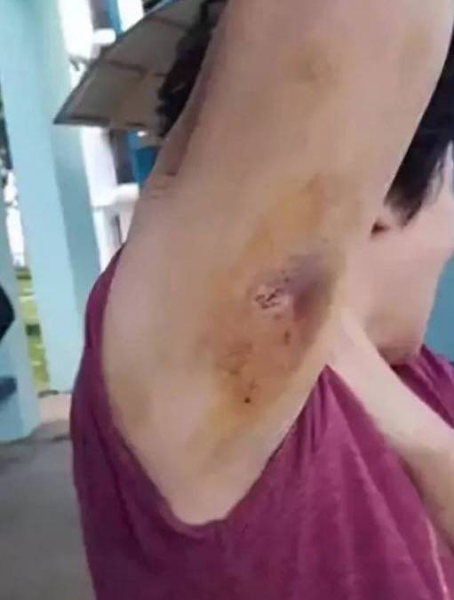 最近，兩人深夜在新加坡遭野豬襲擊，被咬著拖行一米，鮮血淋漓！這個地區要小心