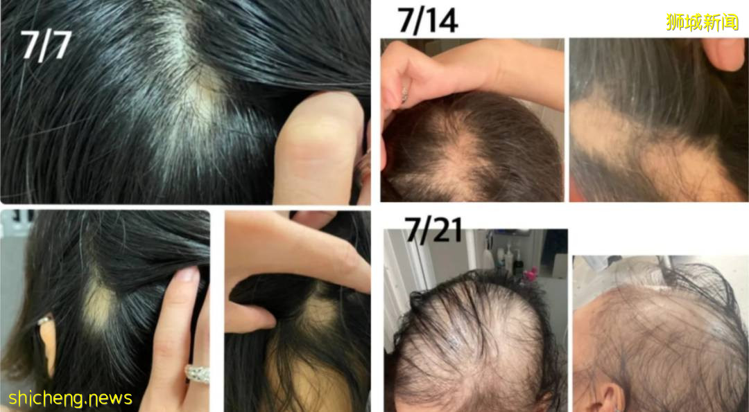 新加坡有人打完2針疫苗後,狂掉頭發!禿了