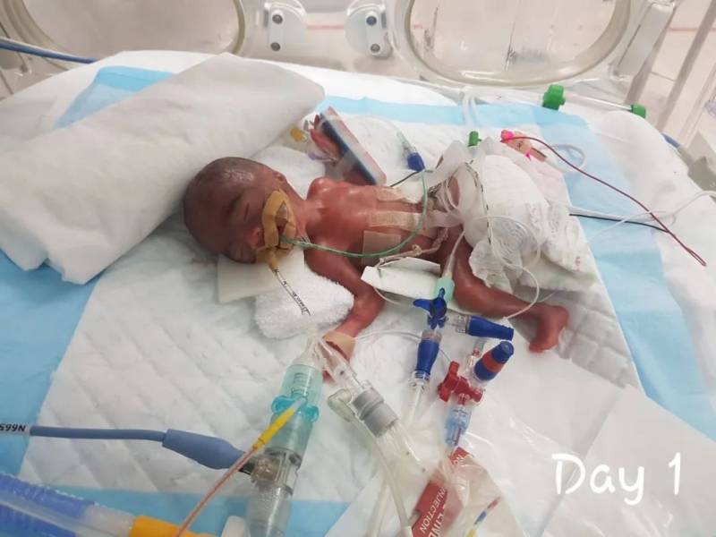 新加坡最輕早産兒僅345克，花了20多萬新幣才救活！新加坡看病到底有多貴