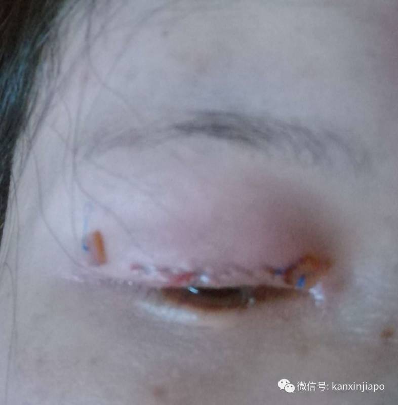 长期戴隐形眼镜导致眼睫毛倒长,手术开刀全过程