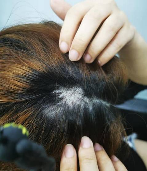 烫头吗?烫到头顶直接“破洞”