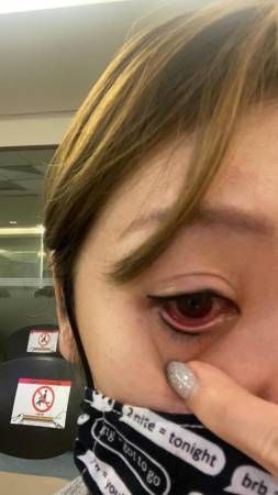 指化学药物滴入   女郎文眼线   疼痛难眠