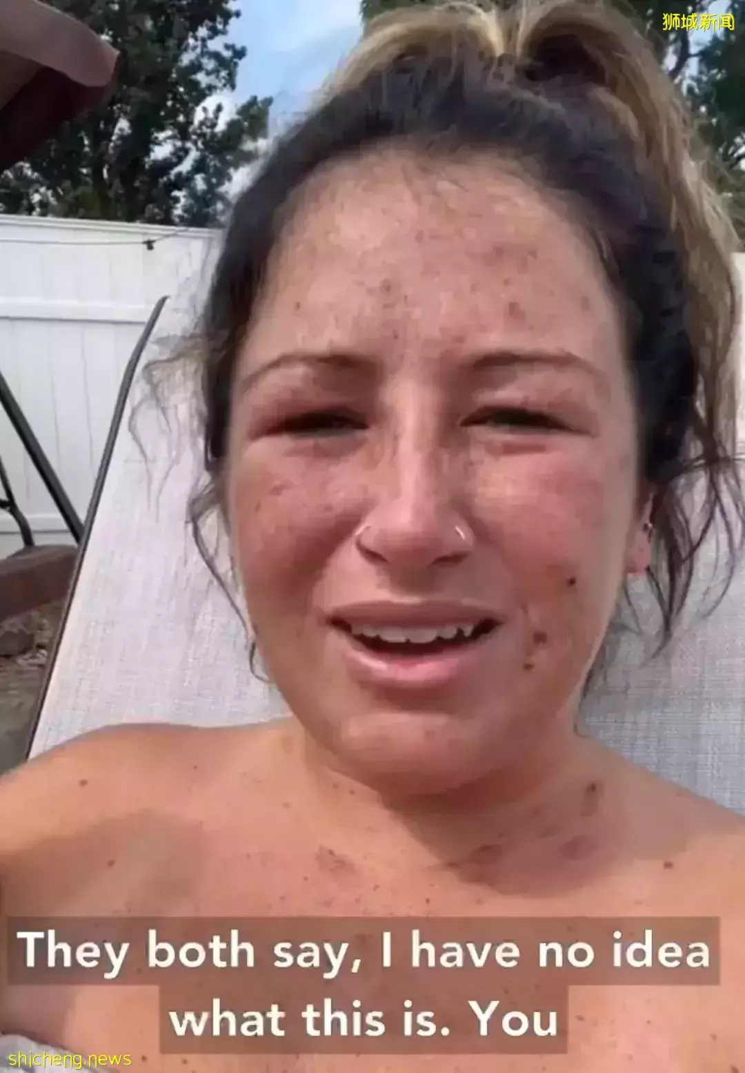 新加坡发现首起本土猴痘病例，源头成谜！患者实拍自述感受！这次会学中国吗