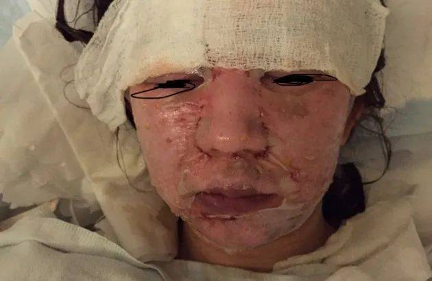 6年前,她在新加坡的中餐馆被毁容!最终获赔10万新币