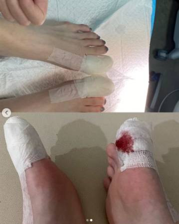 李凯馨脚趾头动手术 权怡凤愿做女儿的轮椅