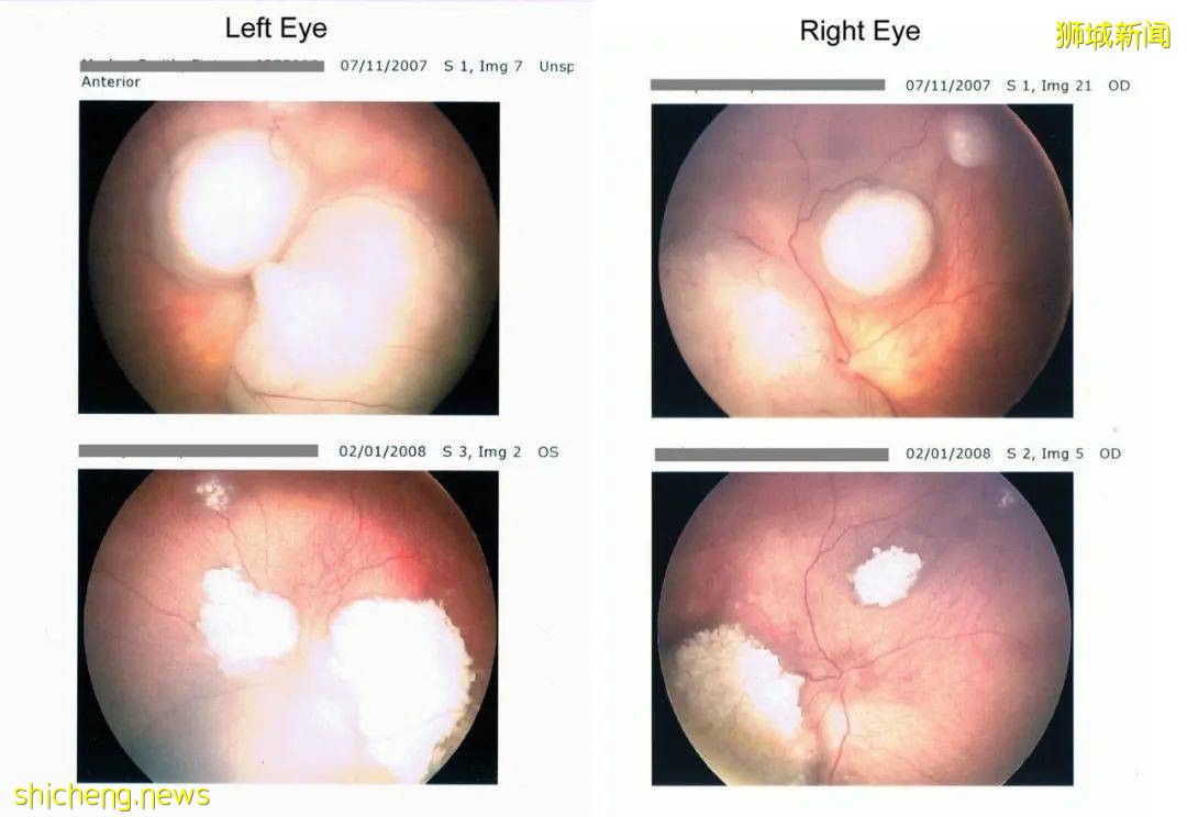 淚目!眼癌、腭裂、呼吸困難……我的寶寶在新加坡剛出生,就開始迎接挑戰