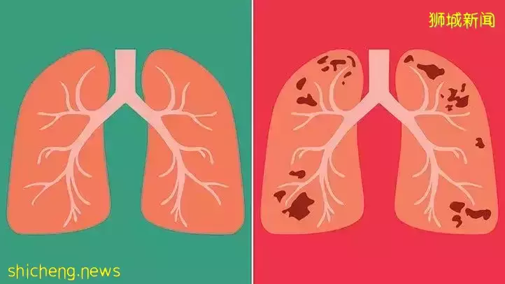 突發!新加坡組屋現不明肺結核感染群,2人死亡!多國曝“新冠+天花”病例,人畜共通