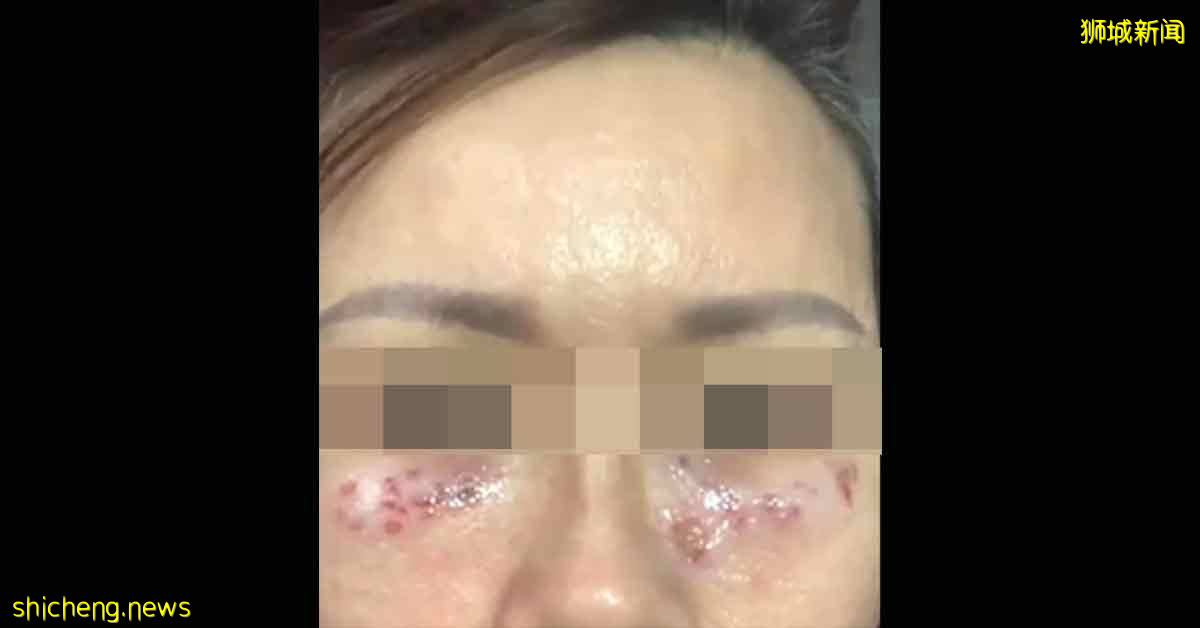 花500多新元 除油粒  爱美安娣 惨遭灼伤