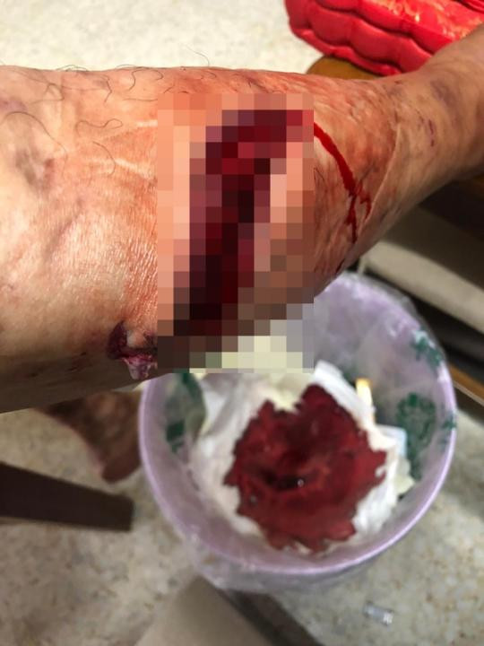 段偉明持電鋸失手 割傷腿 差點見白骨