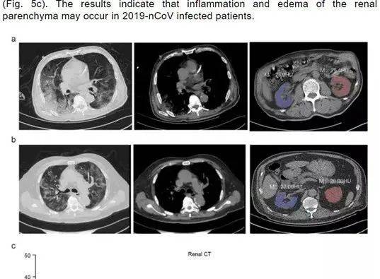 新冠還未過去，更可怕的“新冠後遺症”悄然降臨！新加坡已有客工出現症狀