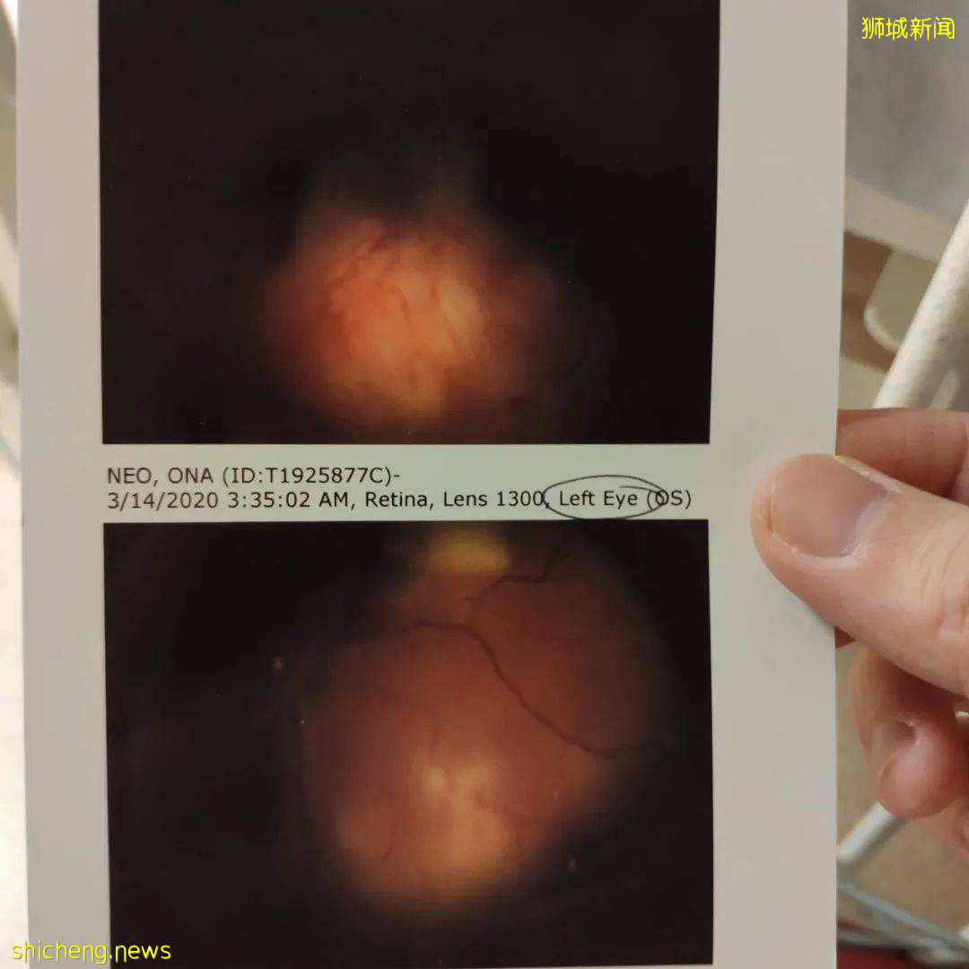 淚目!眼癌、腭裂、呼吸困難……我的寶寶在新加坡剛出生,就開始迎接挑戰