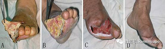 新加坡糖尿病不截肢,国大医院请蛆虫帮忙