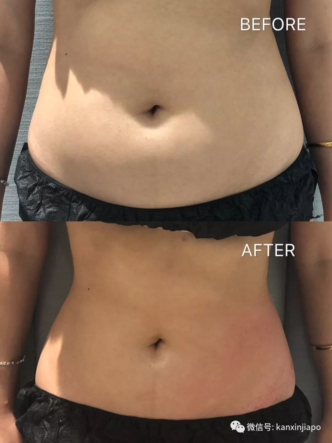 年末最强美肤福利！更有霸王餐免费送！在新加坡也能轻松get磨皮好肤！