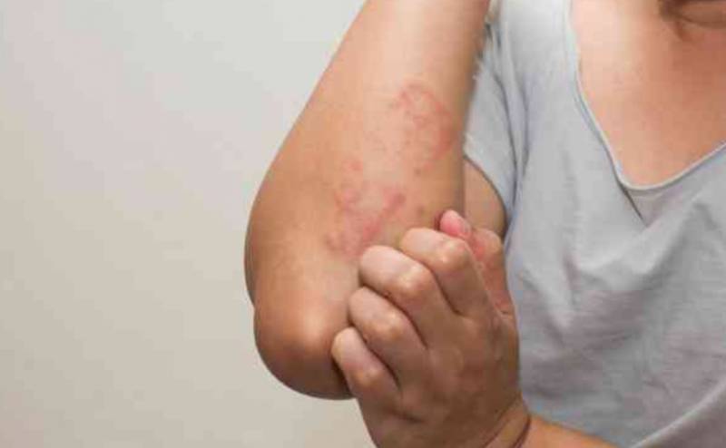 首例!她接種疫苗後嚴重過敏、呼吸急促送急診!新加坡的疫苗也有同款,會安全嗎