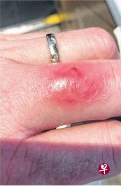 到圣淘沙海滩游玩 一家三口染菌住院3天