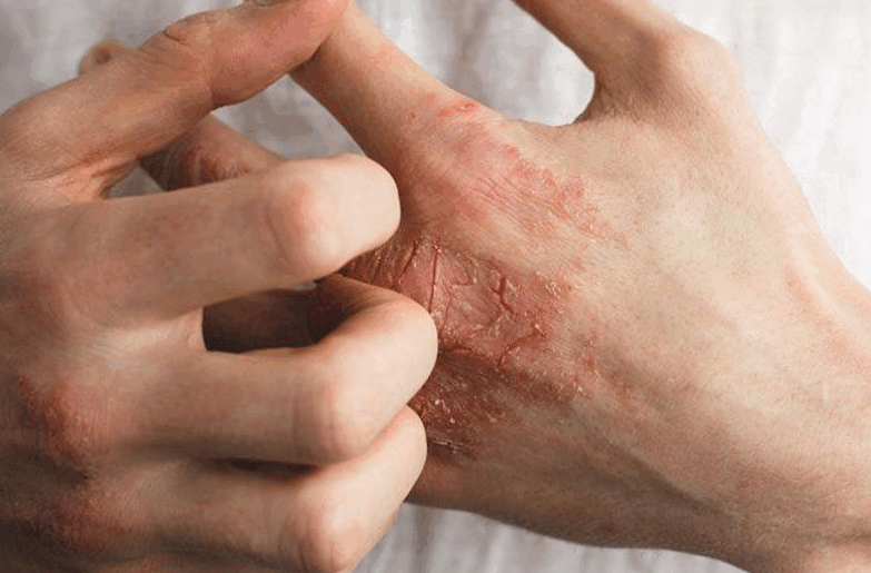 “又红又痒!为什么来了新加坡,我和孩子的皮肤变成了这样......”