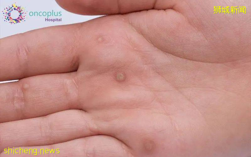 中國貴上天還約不到的HPV，新加坡竟然免費打，女性還能免費體檢