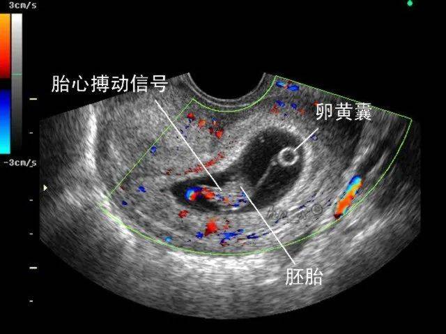 医生嘴里最可怕的两个字——“胎停”,我在新加坡听过