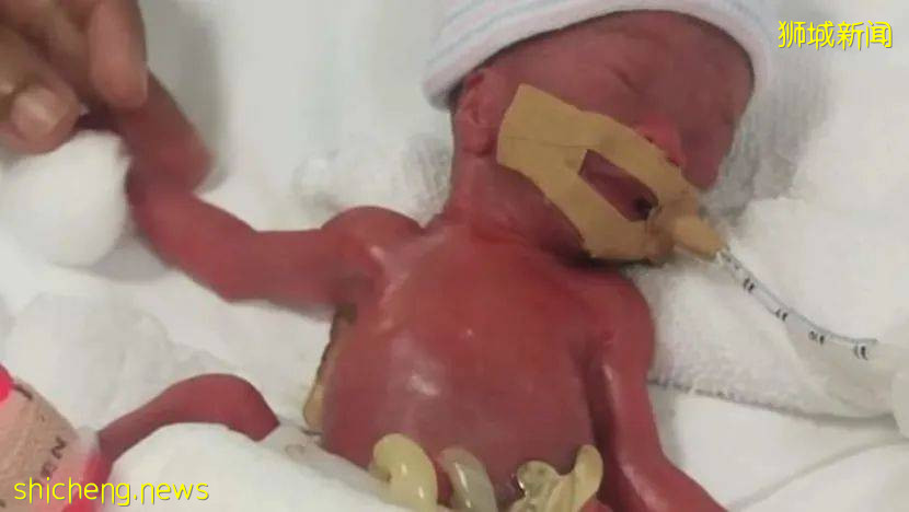 全世界最輕早産兒在新加坡出生,住院13個月後成功回家