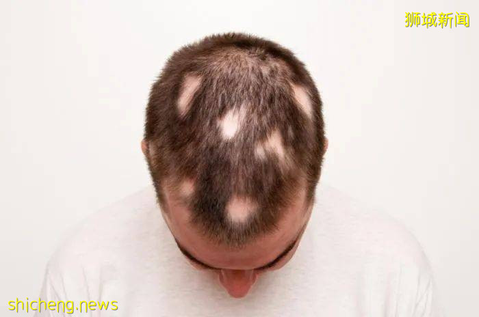 新加坡有人打完2針疫苗後,狂掉頭發!禿了