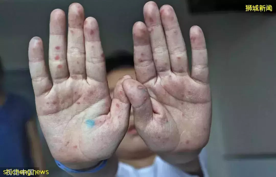 新加坡幼儿园九天24名儿童感染手足口症，家长都不敢送孩子上学