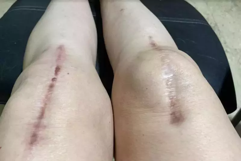 李茵珠两年动两次膝盖手术 共休养10个月