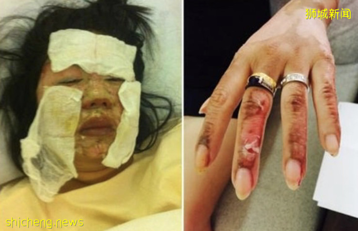 火鍋店火爐爆炸毀臉 女食客索賠逾30萬!