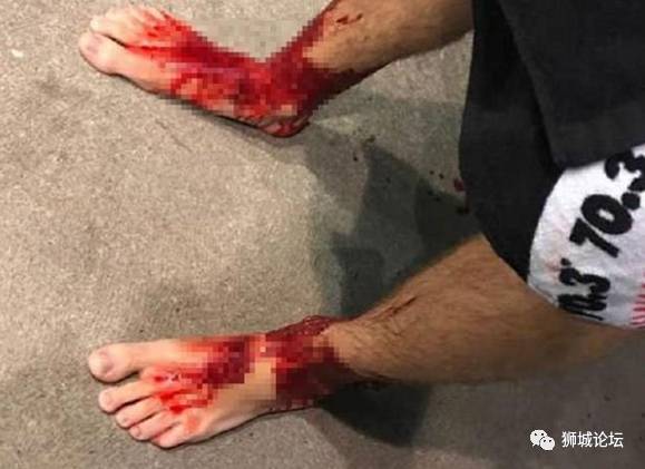澳洲男到沙滩泡了一下脚，居然血腥成这样！在新加坡海滩玩也会这样吗~~~