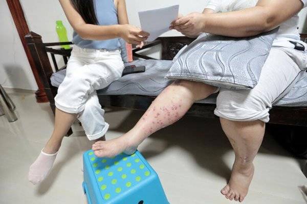 热蜡脱毛致皮肤感染 妇女花钱买难受