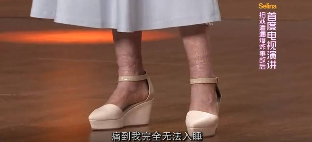 新加坡5死1伤车祸：为救男友80%烧伤的美女歌星，刚脱离危险！她还得面对这些