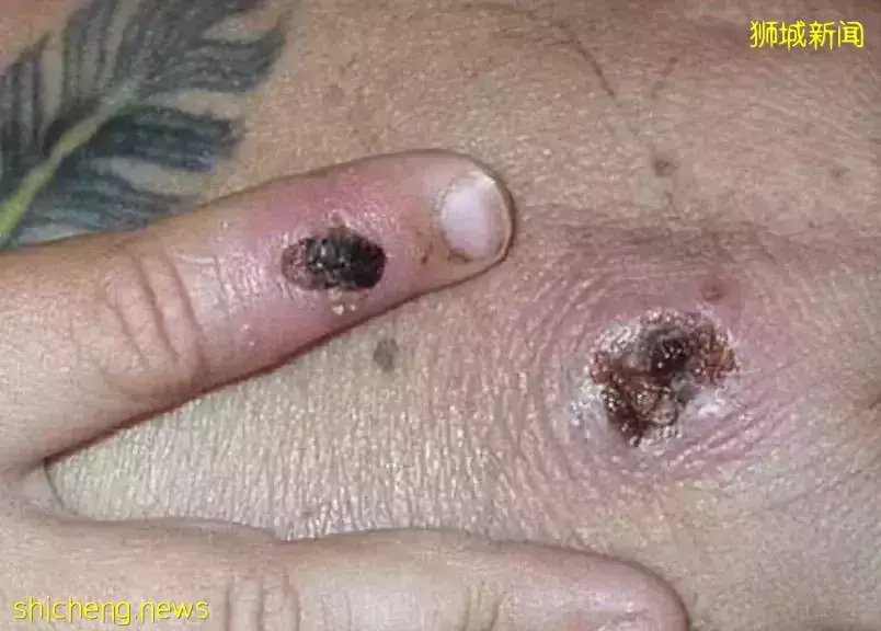 突發!新加坡組屋現不明肺結核感染群,2人死亡!多國曝“新冠+天花”病例,人畜共通