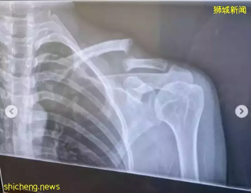 赵彩聆脚车事故锁骨骨折 下周动手术