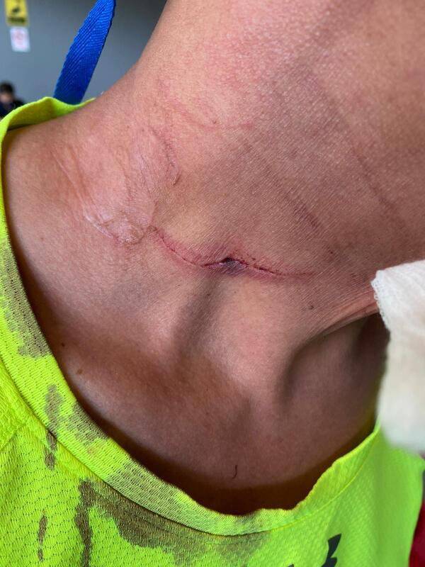 阿嫂砸酒瓶   划伤阿叔颈