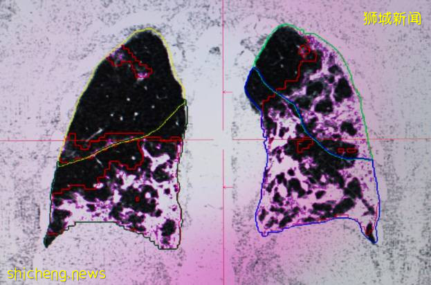 傳染病學專家:不接種疫苗的人,身體將成爲變異病毒工廠