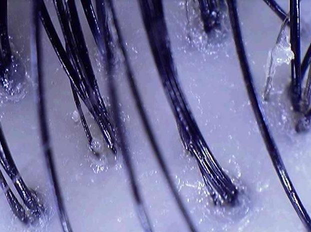 在线等，急！新加坡让我的头皮变大油田，怎么办？