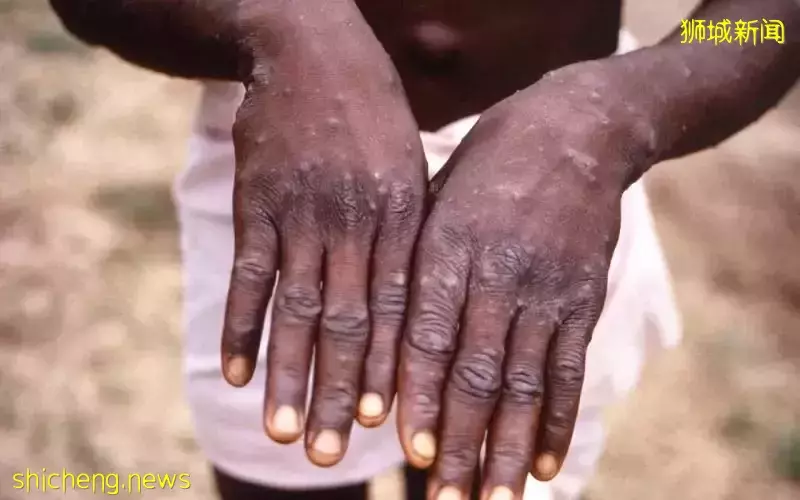 卫生部：本地未出现猴痘确诊病例