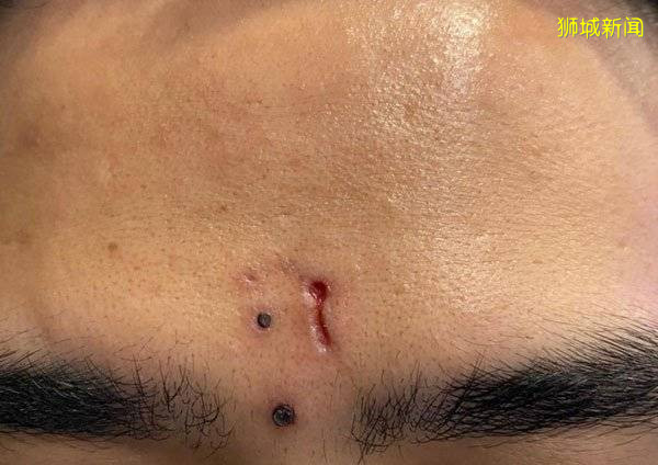 男子稱"洗壞臉" 3個暗瘡疤 索賠1.5萬