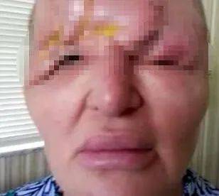 疫苗最新发现!这个副作用让整容人士崩溃