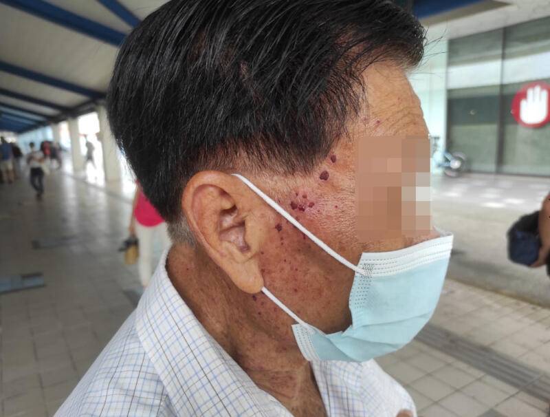 老翁洗脸被要价1.3万‧美容院：去除220个油泡