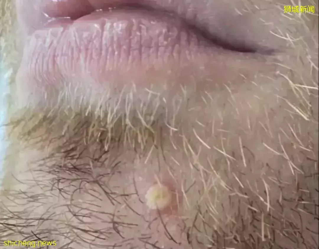 新加坡发现首起本土猴痘病例，源头成谜！患者实拍自述感受！这次会学中国吗