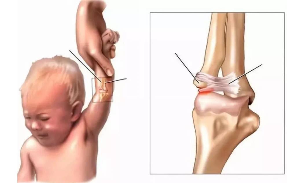 又一起虐童案?新加坡16个月女童手臂脱臼,老师被警方调查